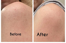 Load image into Gallery viewer, First Aid Beauty KP Bump Eraser Body Scrub with 10% AHA 226 g