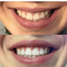 Load image into Gallery viewer, Beaute. The Original Glam Teeth Whitening Kit
