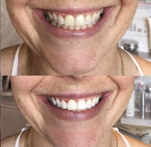 Load image into Gallery viewer, Beaute. The Original Glam Teeth Whitening Kit
